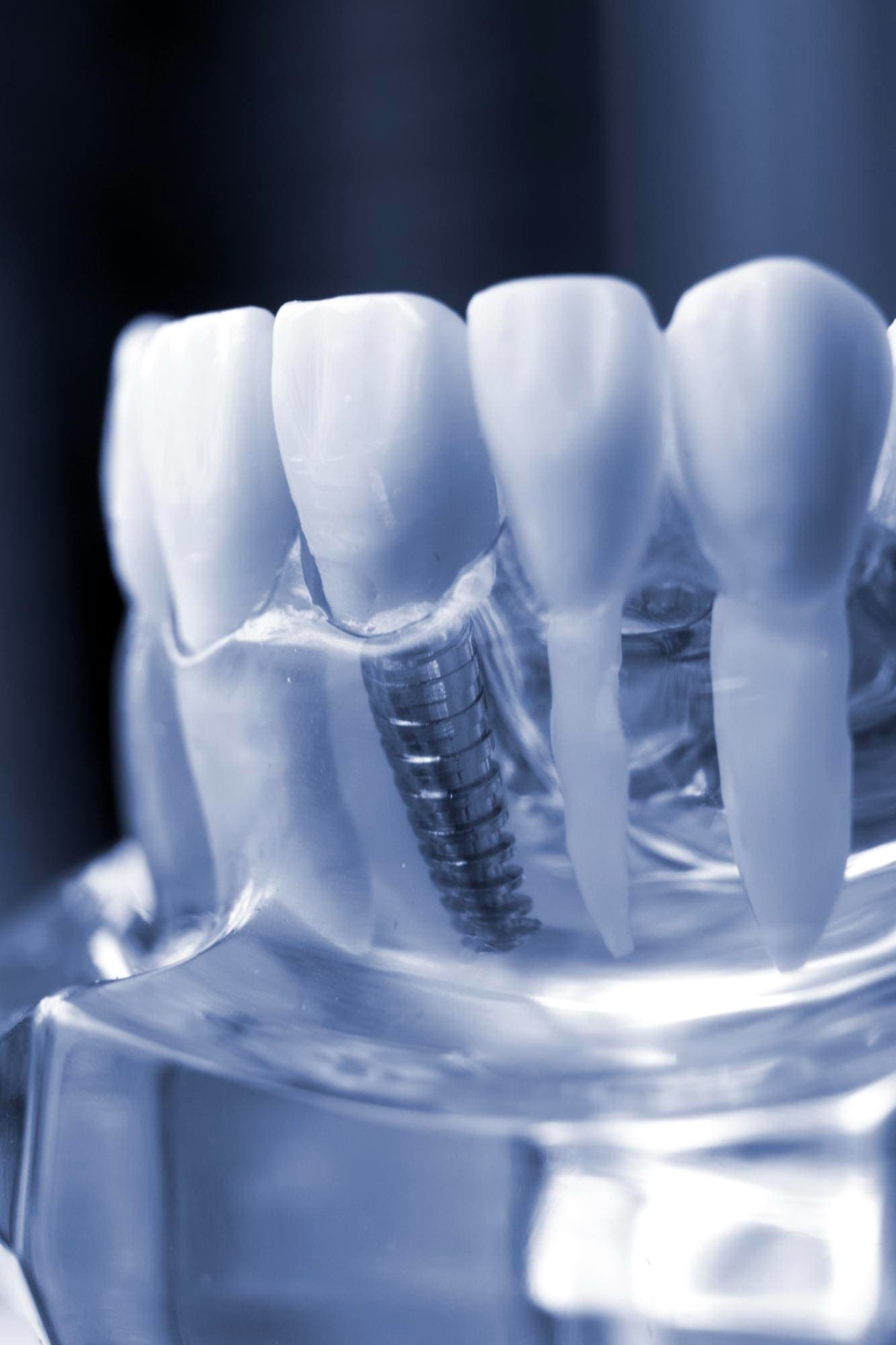 Implantes Dentários